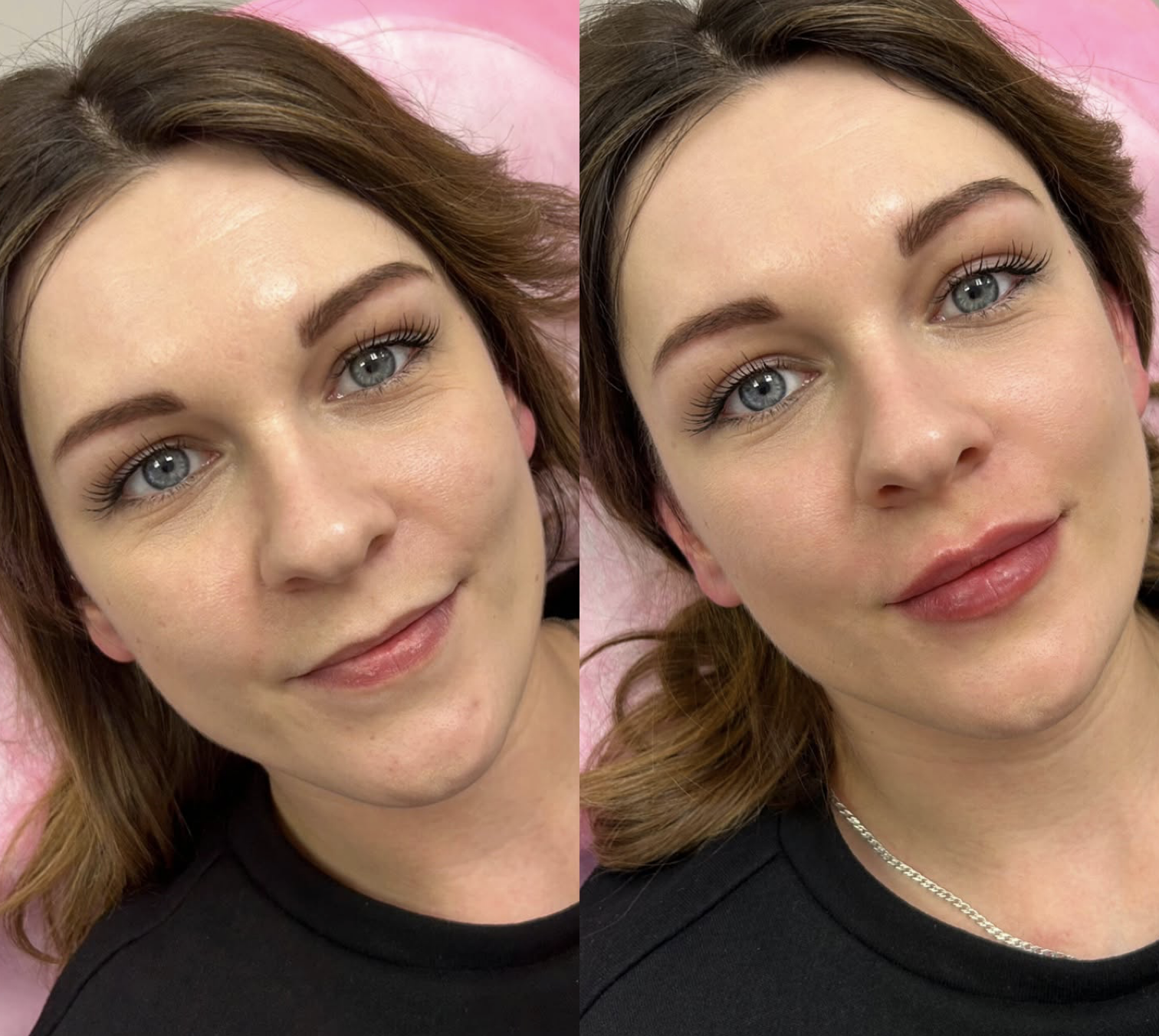 Efekt zabiegu — modelowanie twarzy, przed i po